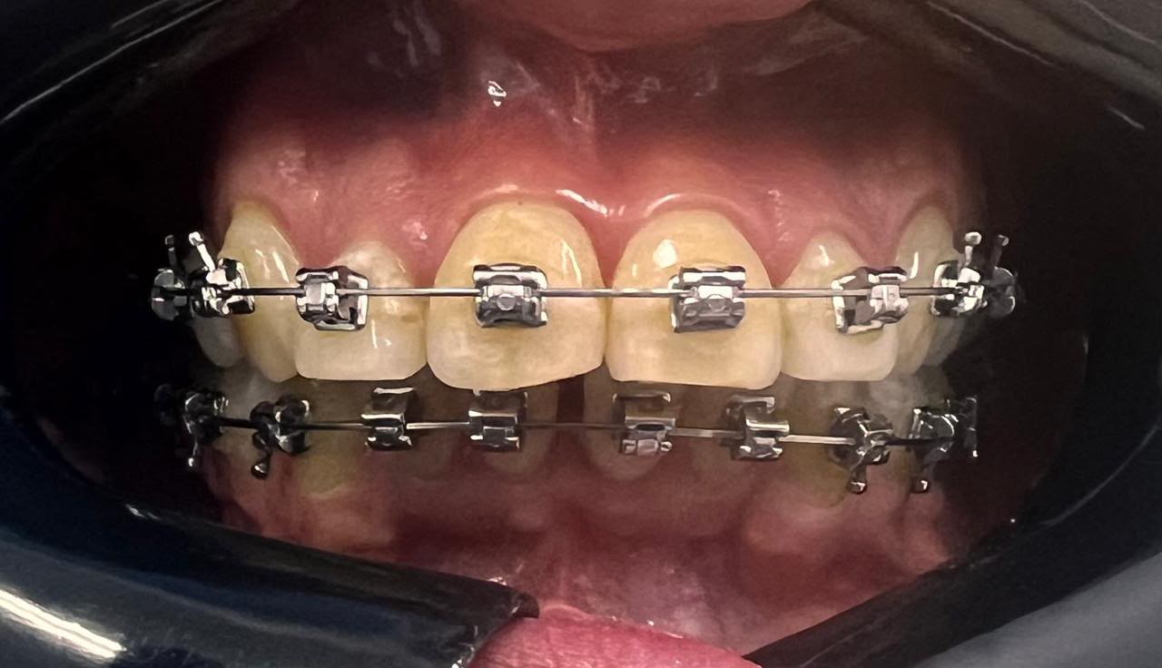 Caso 3 de ortodoncia en Alto Olivar Clínica Dental