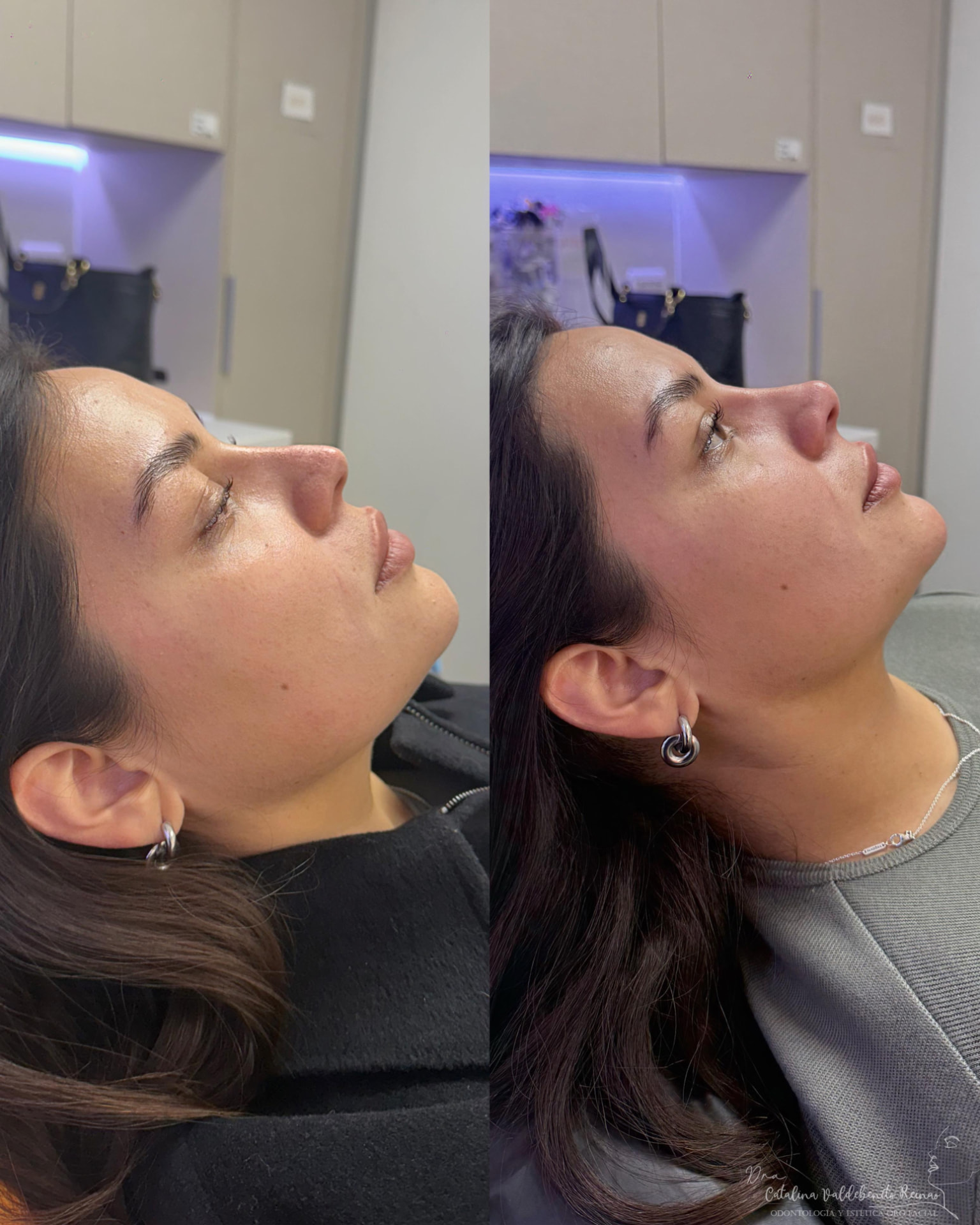 Antes y después de una rinomodelación en Alto Olivar Clínica Dental