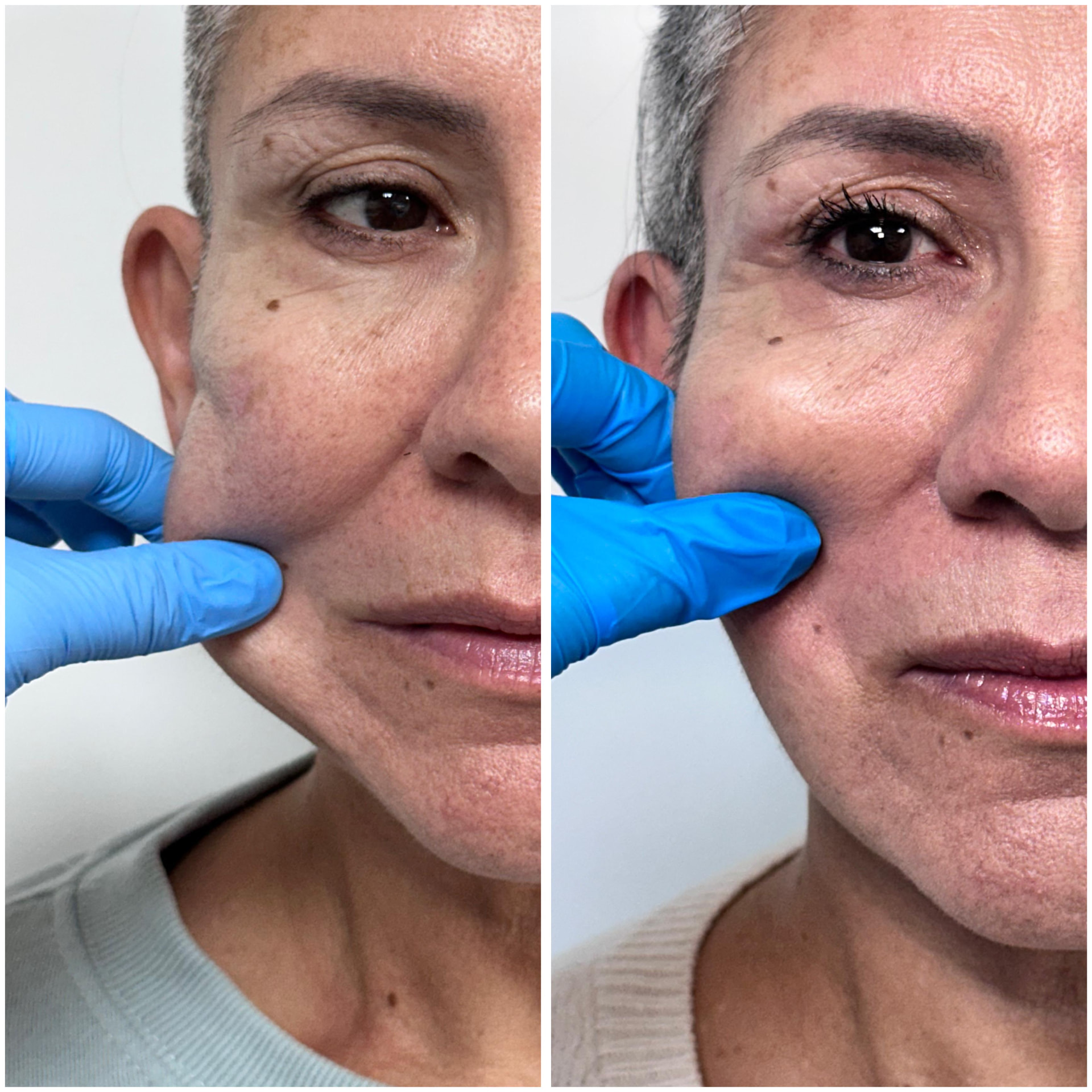 Antes y después de un tratamiento con bioestimulador de colágeno en Alto Olivar Clínica Dental