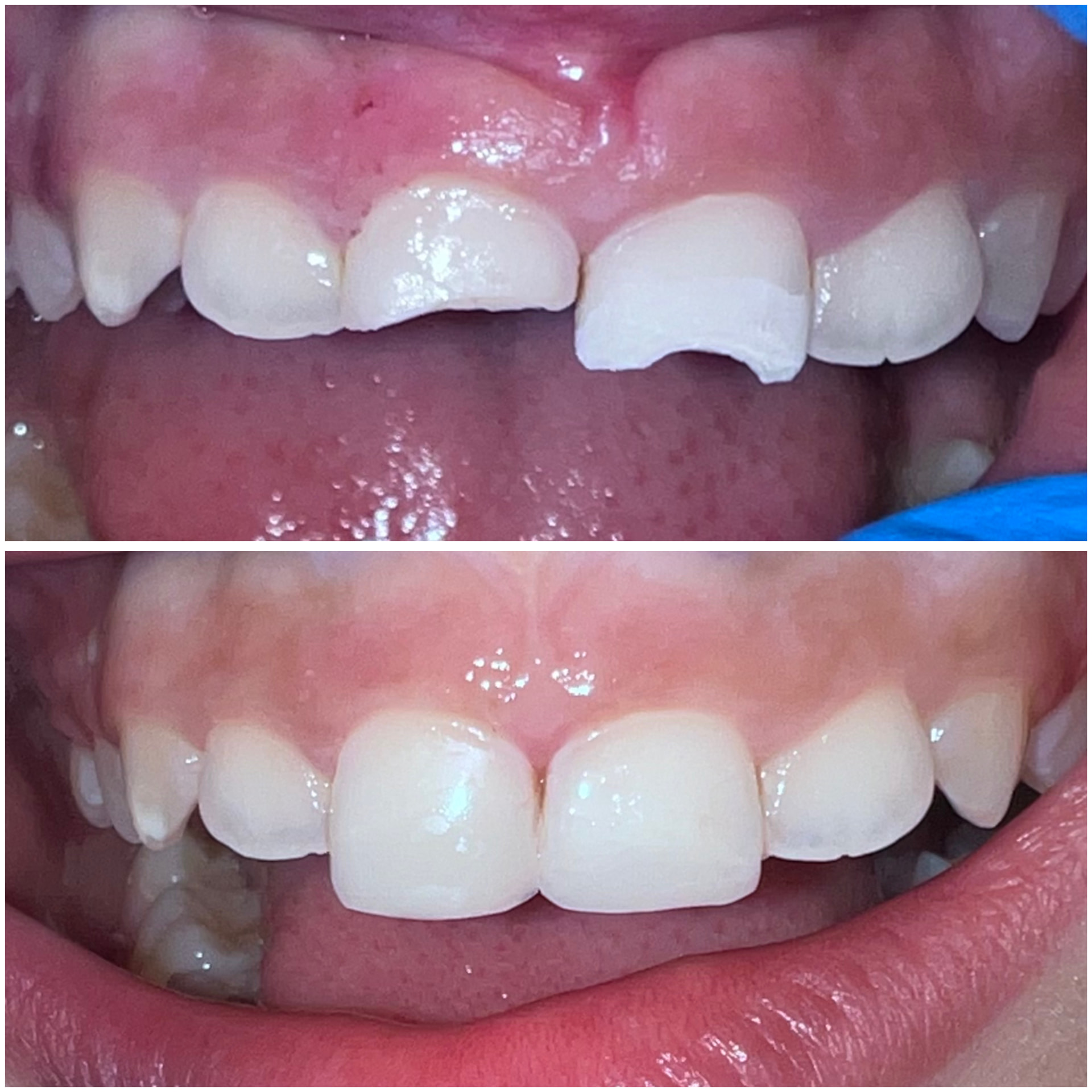 Antes y después de la reparación de un traumatismo dentoalveolar en Alto Olivar Clínica Dental