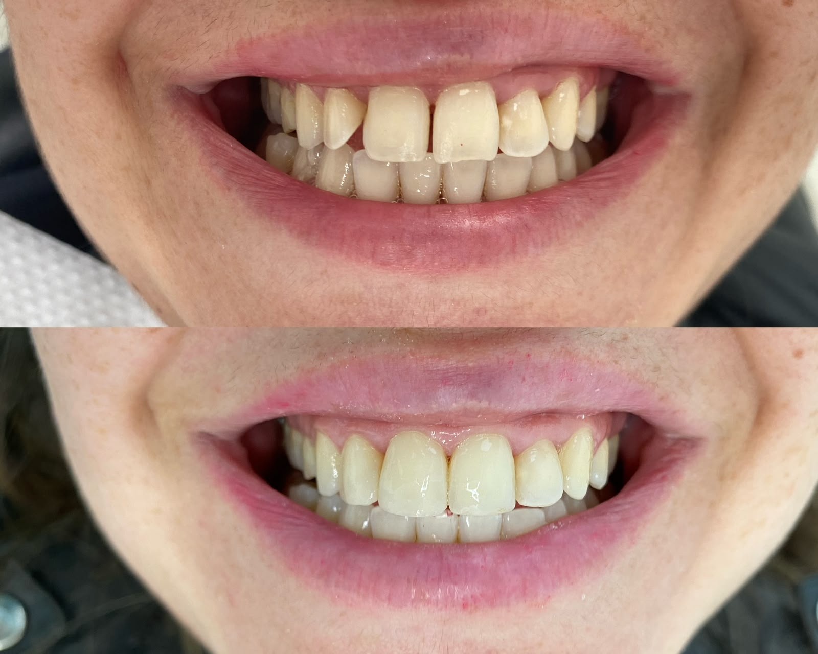 Antes y después de un cierre de diastemas en Alto Olivar Clínica Dental