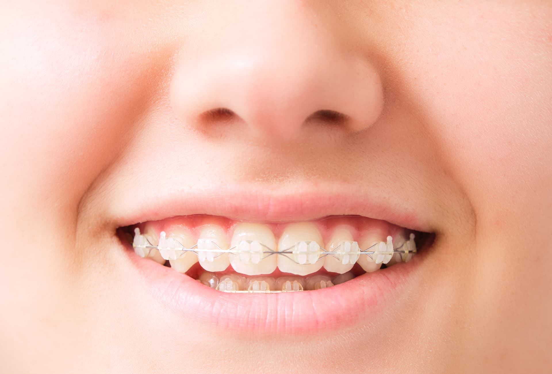Brackets metálicos o estéticos: ¿cuál elegir?