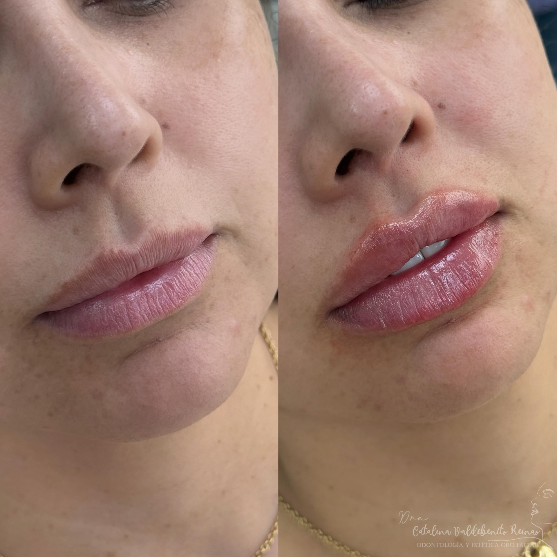 Antes y después de un relleno de labios en Alto Olivar Clínica Dental