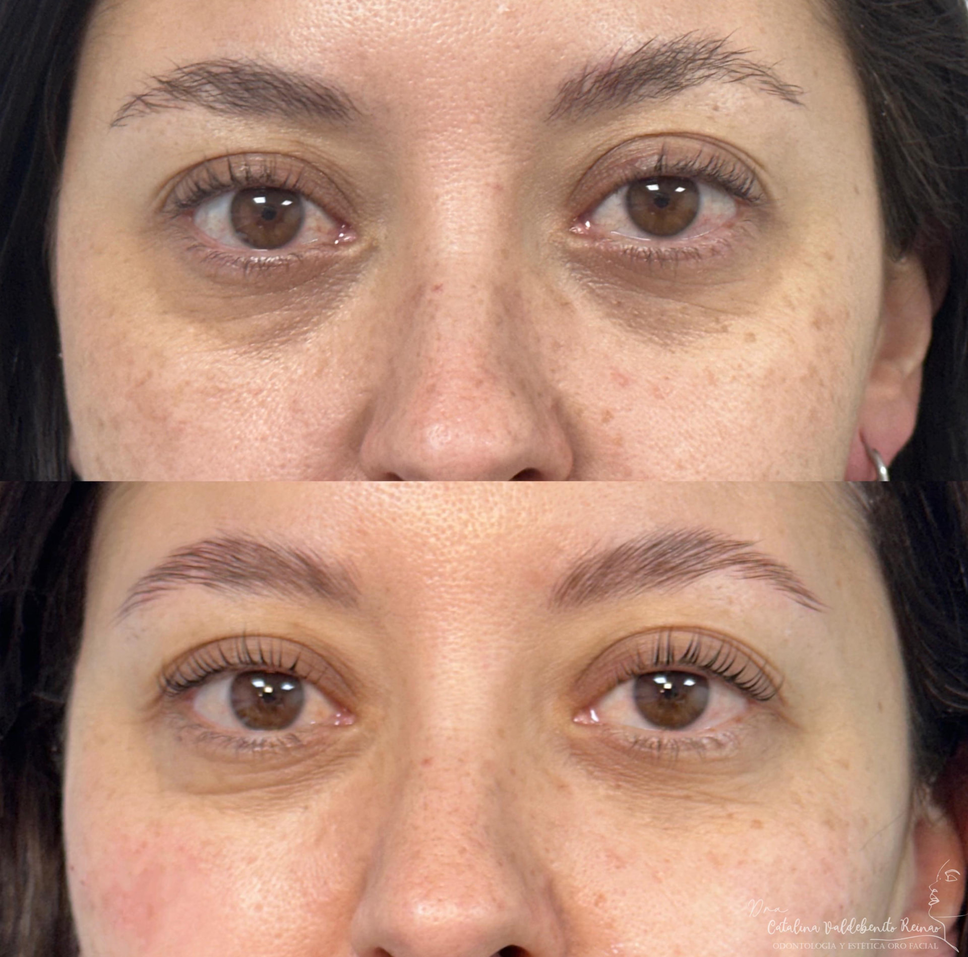 Antes y después de la armonización y relleno de ojeras en Alto Olivar Clínica Dental