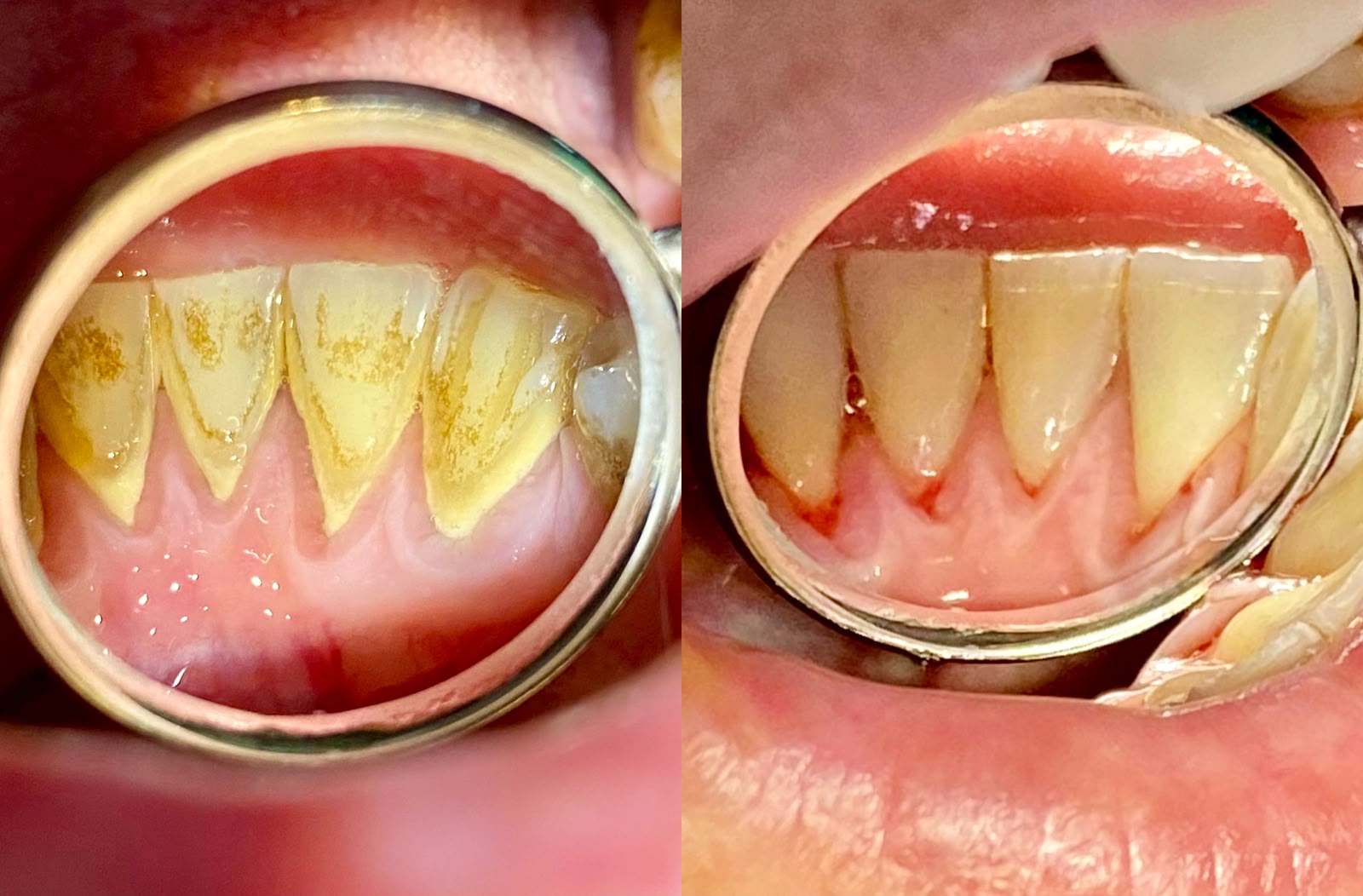 Antes y después de una limpieza dental en Alto Olivar Clínica Dental
