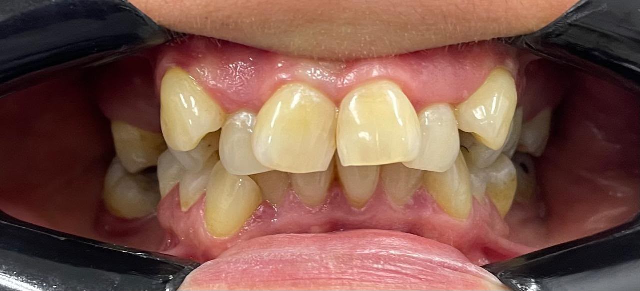 Caso 1 de ortodoncia en Alto Olivar Clínica Dental