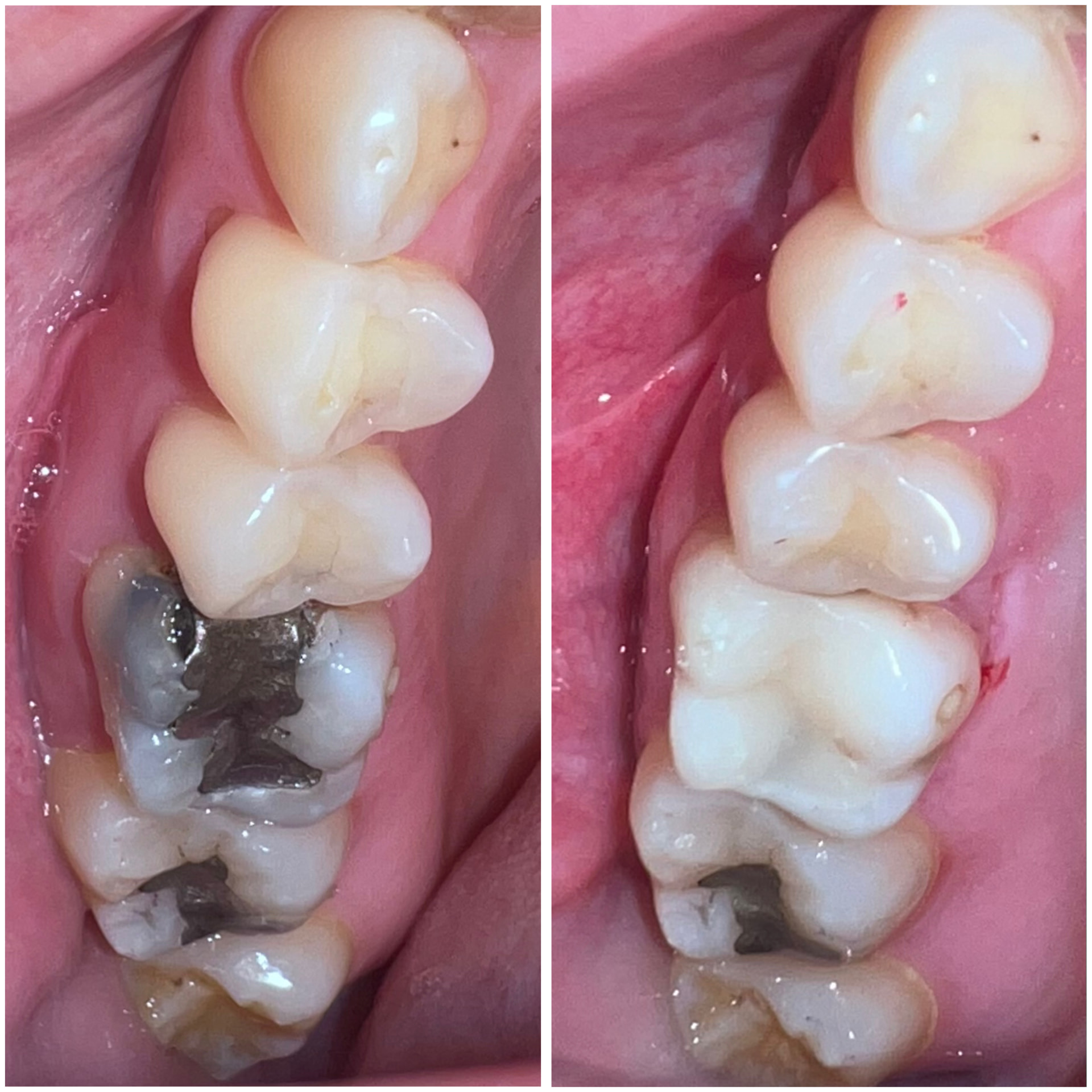 Antes y después de resinas compuestas en Alto Olivar Clínica Dental
