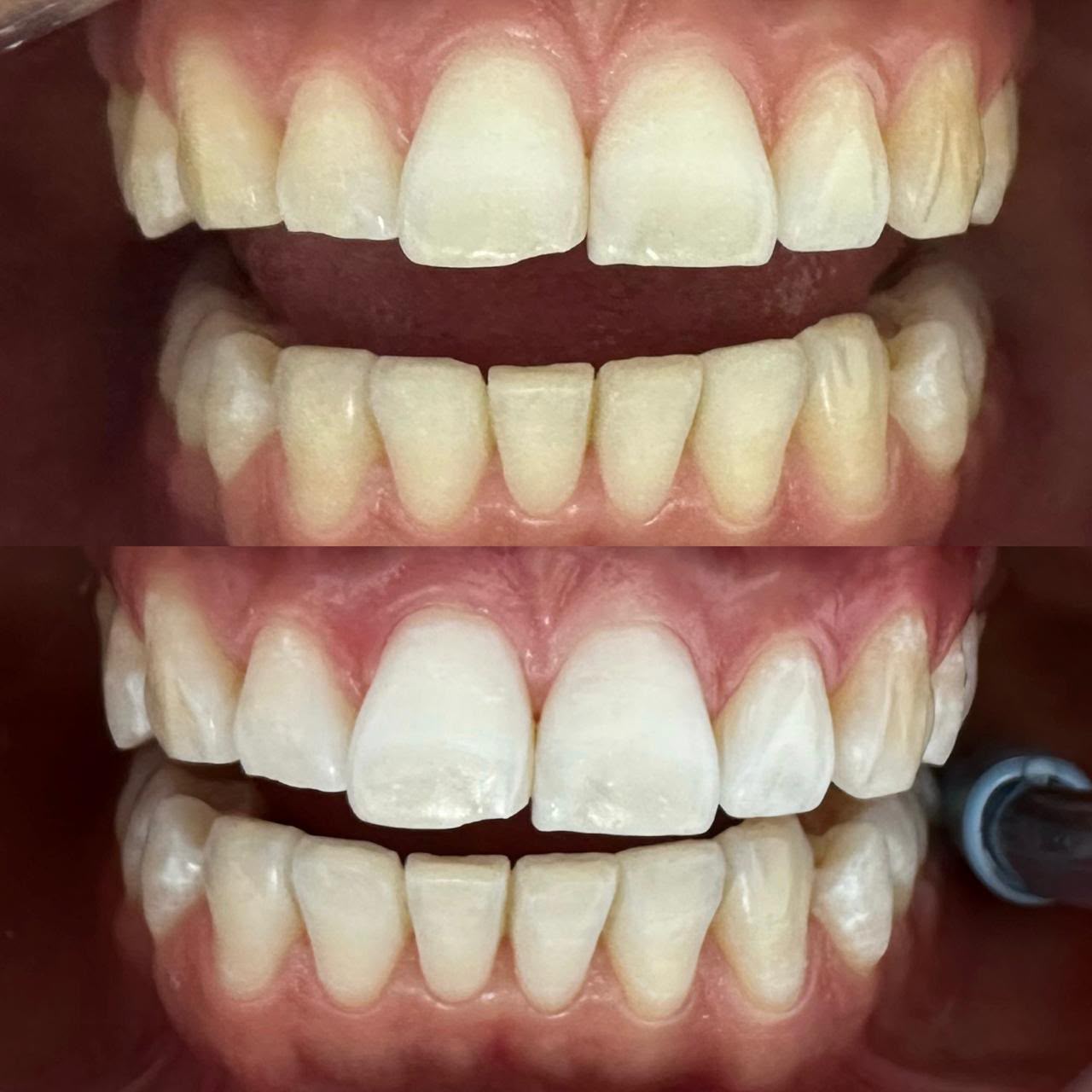 Antes y después de un blanqueamiento dental en Alto Olivar Clínica Dental