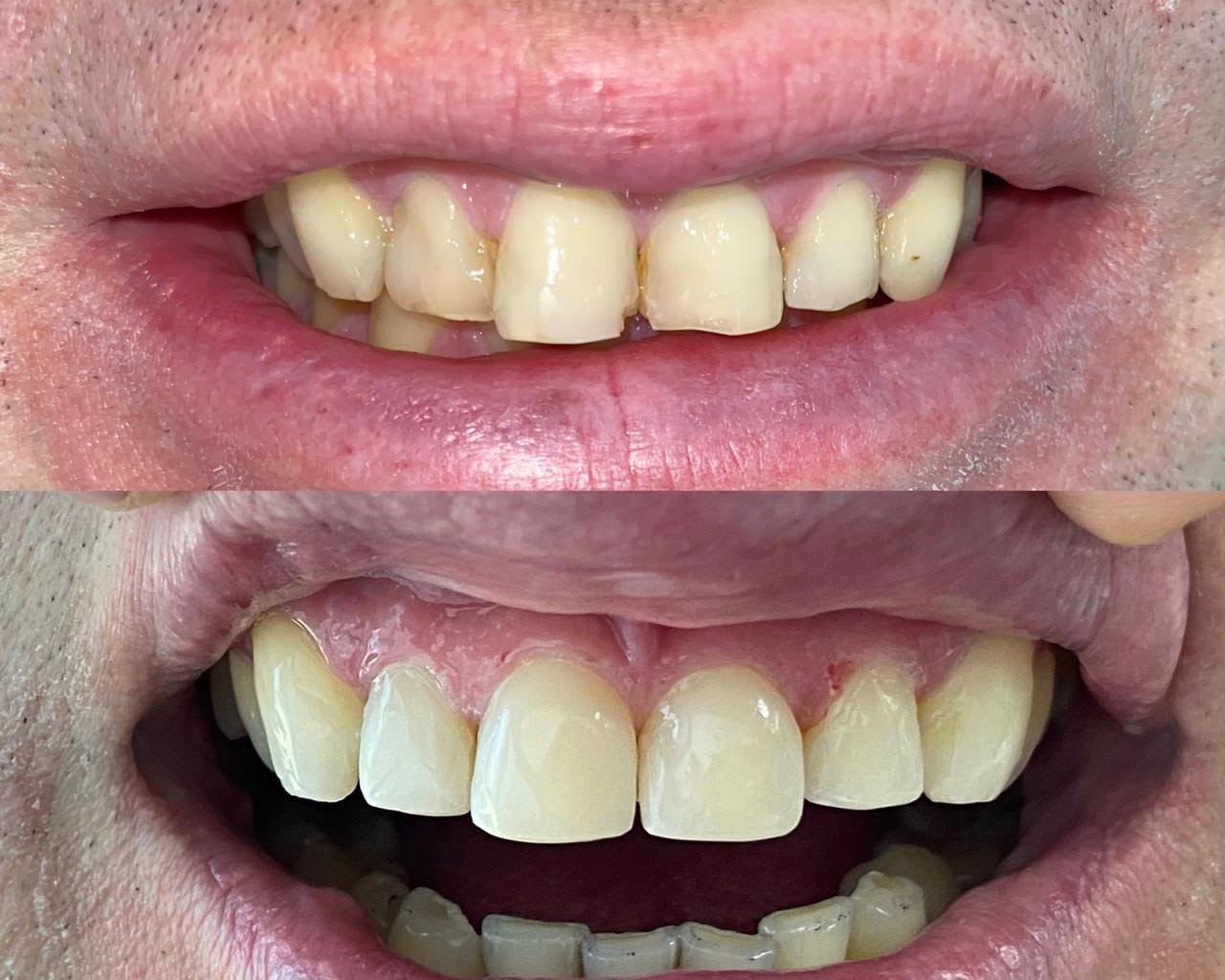Antes y después de una rehabilitación estética con resina compuesta en Alto Olivar Clínica Dental