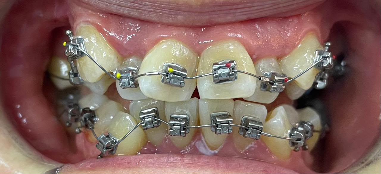 Caso 2 de ortodoncia en Alto Olivar Clínica Dental