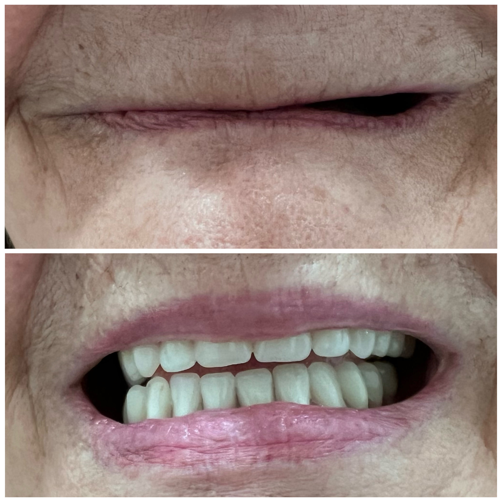Antes y después de una prótesis dental en Alto Olivar Clínica Dental