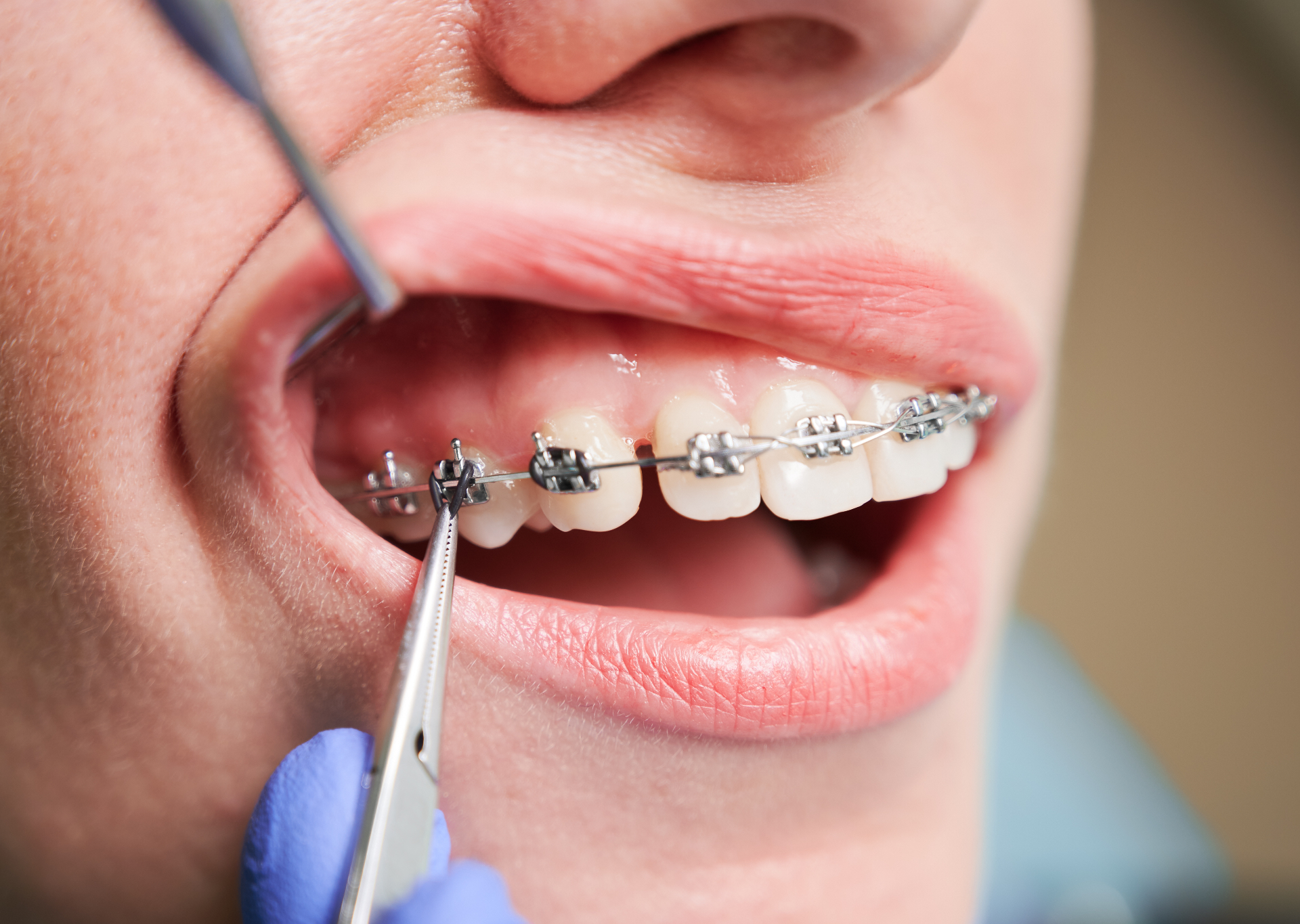 Ortodoncia invisible vs brackets: ¿cuál elegir?