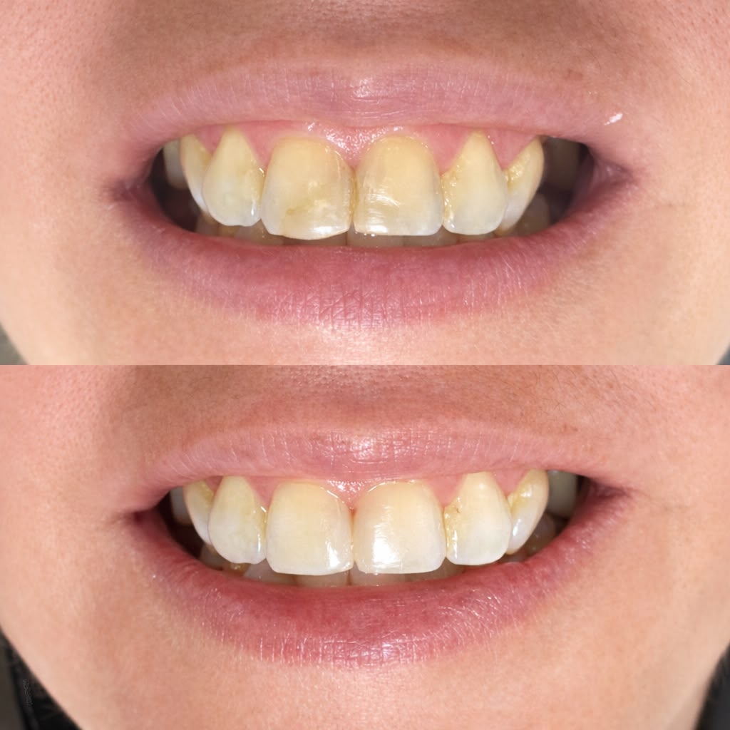 Antes y después de una armonización dental con resina compuesta en Alto Olivar Clínica Dental